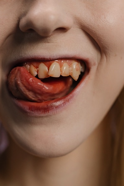 Close up of crooked fangs that appear to have some blood on them. The person is licking the top row of the teeth. The person is extremely pale. Photo by cottonbro on Pexels